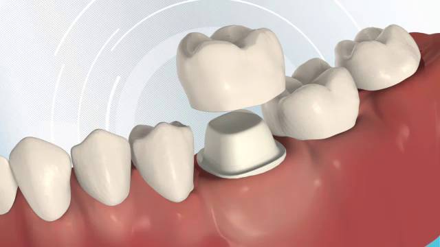dental crown after root canal treatment