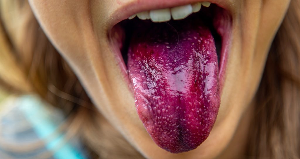 red rashes on tongue