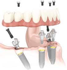 All On 4- Dental Implant Surgical Technique