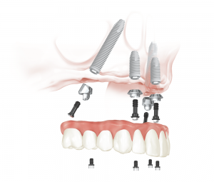 find the best All on 4 clinics for full jaw implant
