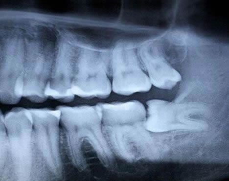 wisdom teeth x-ray