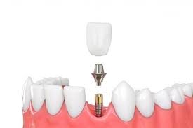 Dental Implant & Zirconia Crown- Promotion