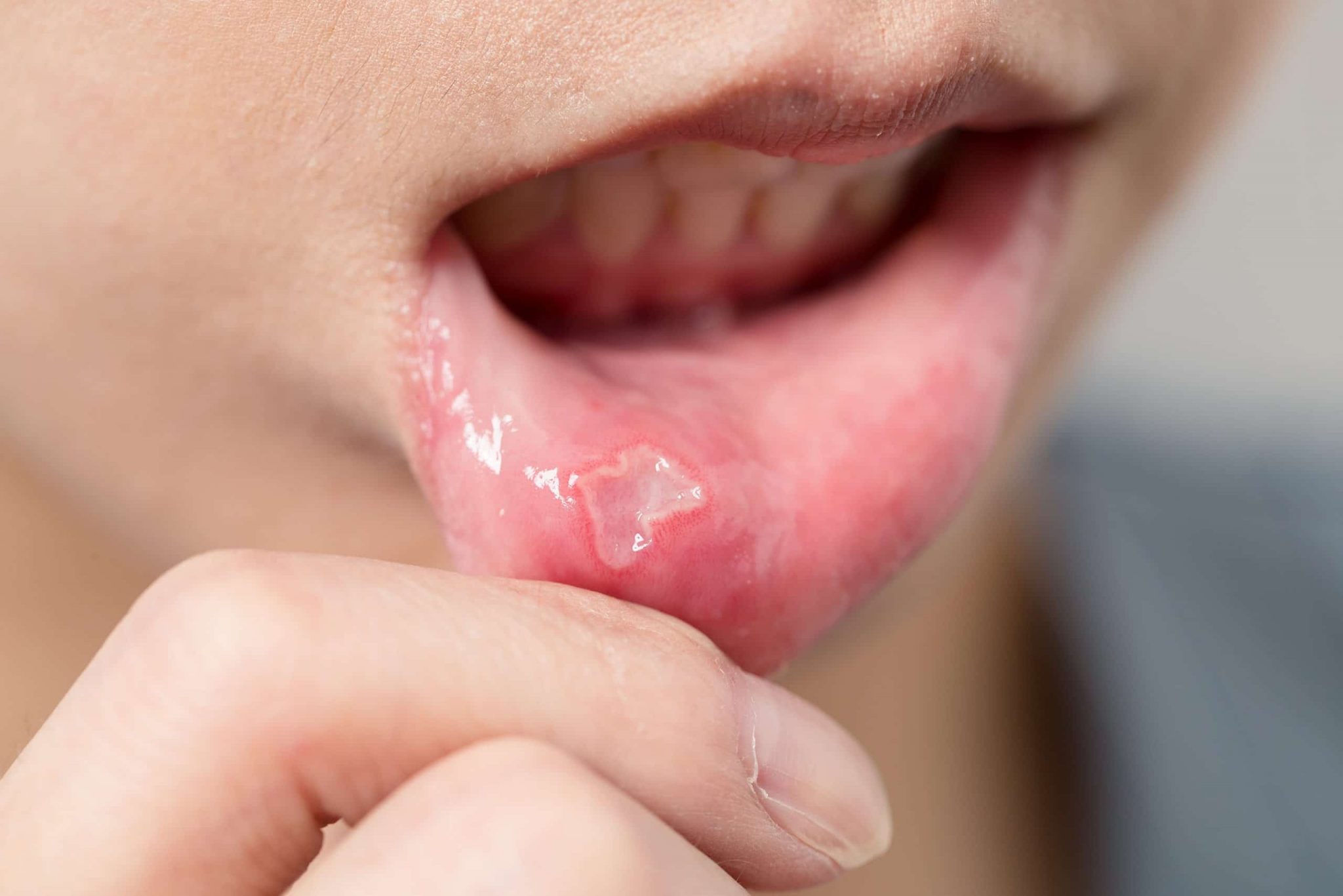 Why do I keep getting canker sores and what to do with it.