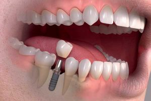 Top 12 Dental Implant Brands