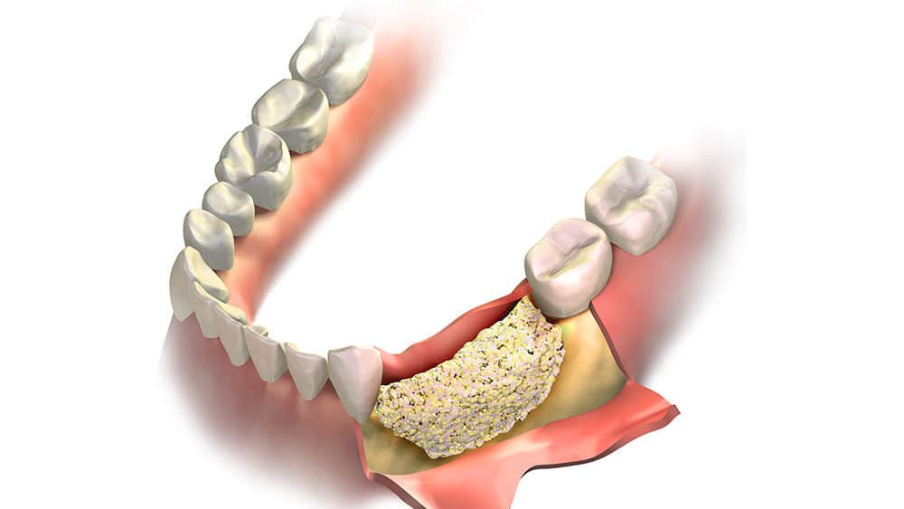 What are the different types of dental graft