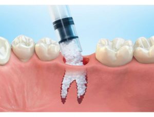Types of Dental Bone Graft with pdf download