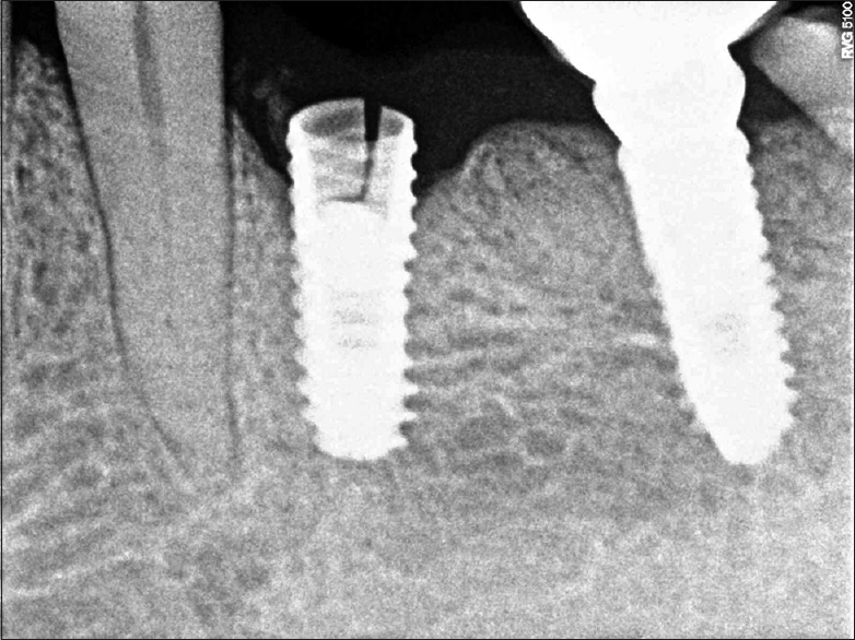 How long do dental implants last? Photo shows a fractured dental implant