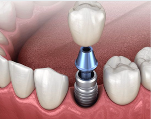 Single Dental Implant and Crown Promotion DentistConsultationHub