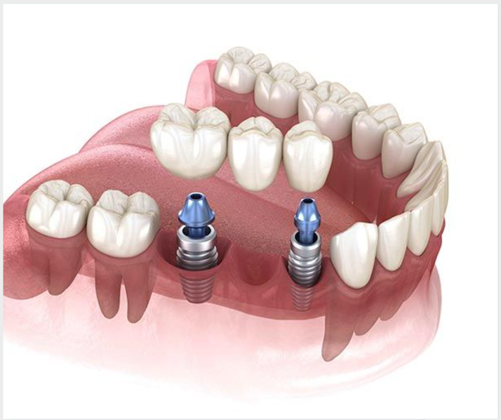 3-Teeth Dental Implant Bridge Promotion Thailand
