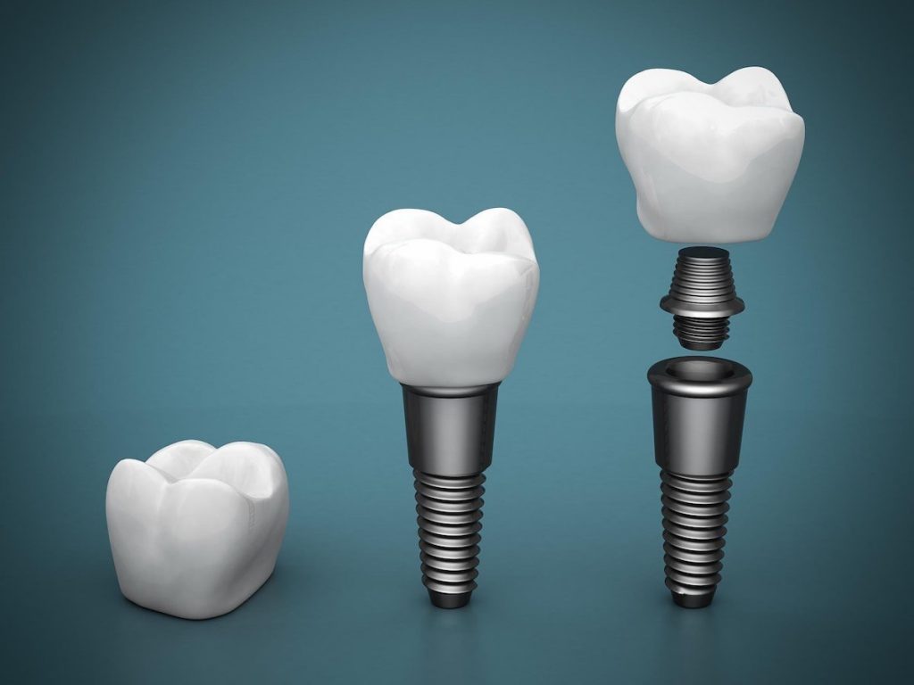 Why are dental implants so expensive in Australia?