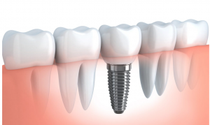 Advanced Dental Group Dental Implants