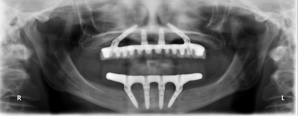 All On 4 Dental Implant Consultation