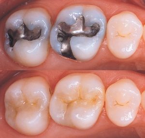 White Fillings Before and After